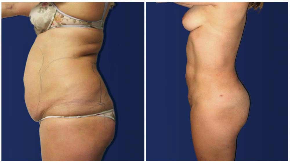 Liposuction Female Patient (32 years)